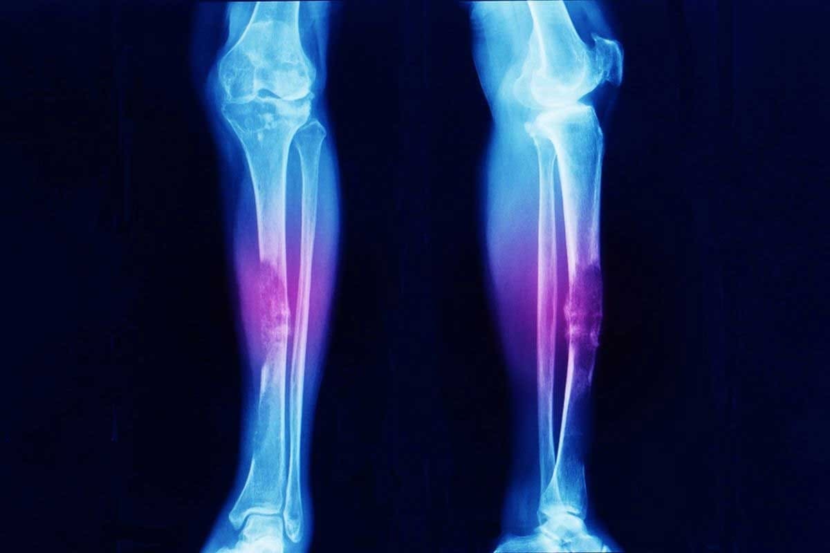 Ewing Sarcoma Staging: 7 Key Facts