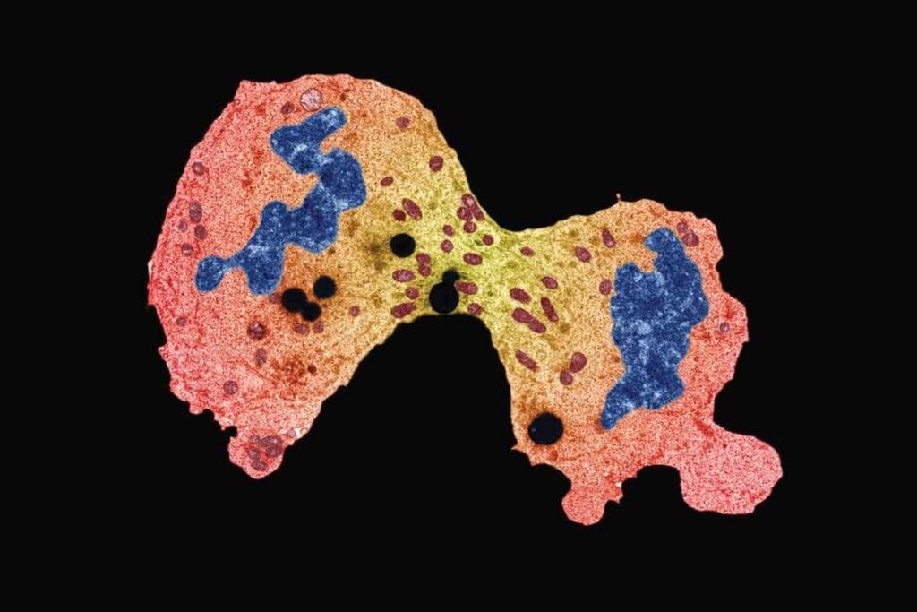 Ewing Sarcoma Cancer Survival Rate: 7 Key Facts