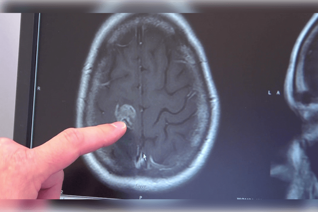 Why Can a CT Scan Miss a Brain Tumor? Understanding Detection Limits and Alternatives