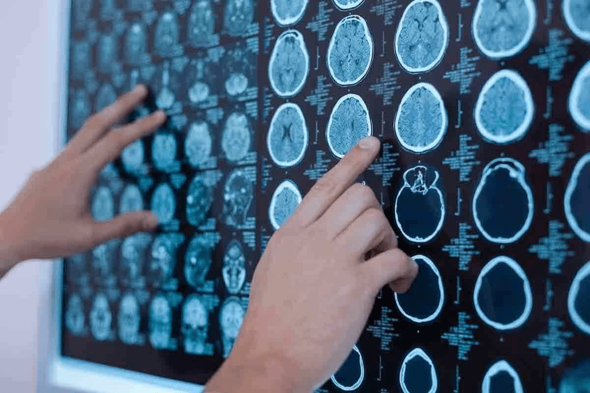 How to Get Rid of Brain Cancer: Step-by-Step
