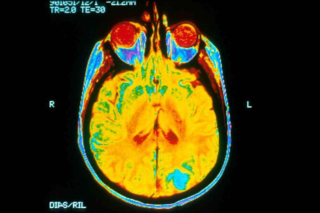 Brain Cancer Imaging: 7 Breakthroughs