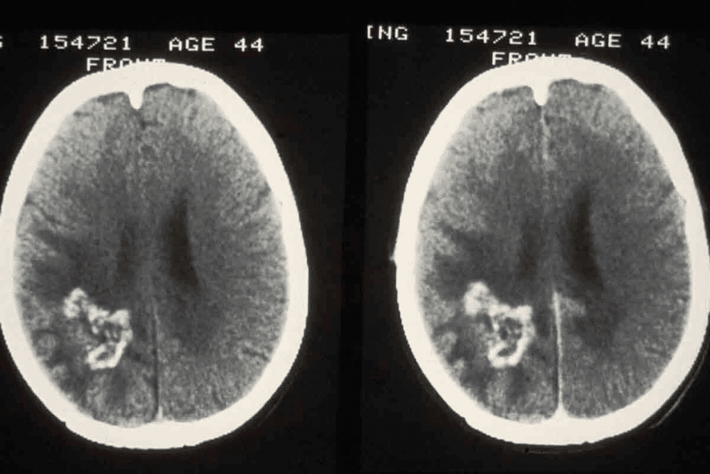 Malignant Brain Tumor MRI: 7 Key Signs