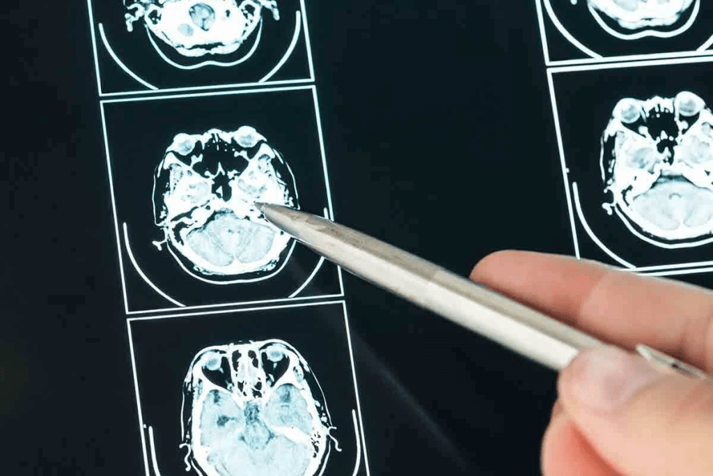 Malignant Brain Tumor MRI: 7 Key Signs