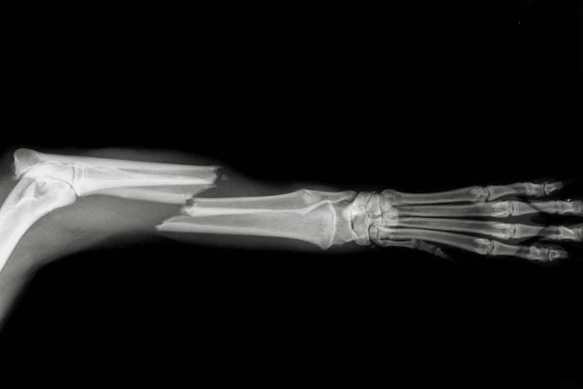 Will an MRI Show Broken Bones That X-Ray Cannot?