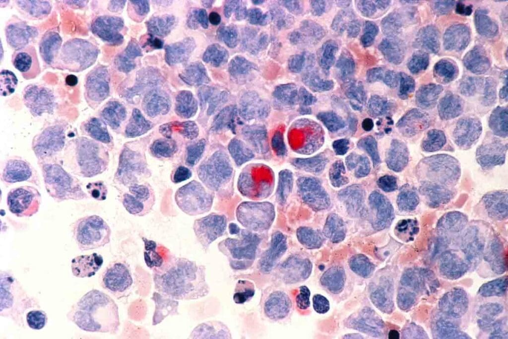 Leukemia Dark Spots on Spine: Causes