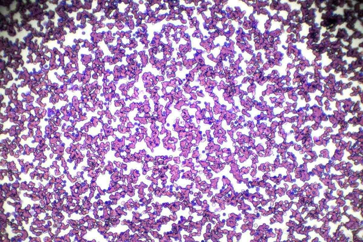 Risk Factors for ALL: 10 Essential Points