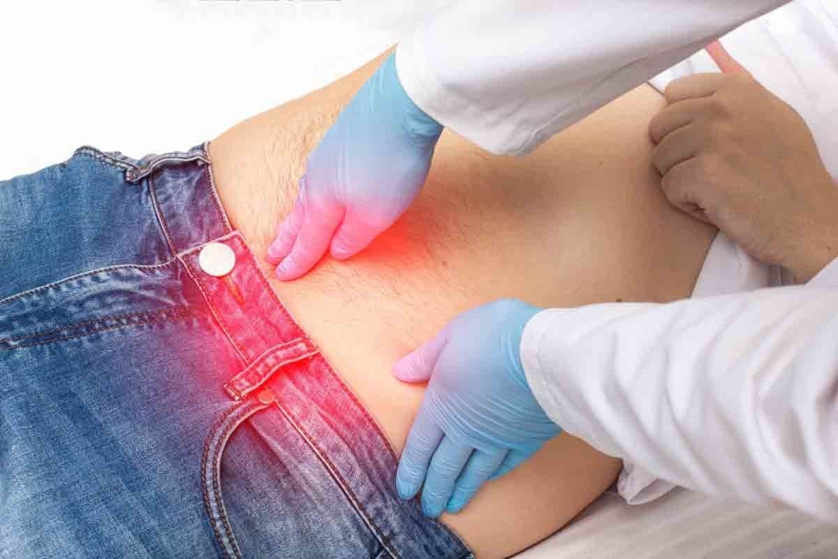 Abdominal Hernia Spigelian: 8 Vital Facts