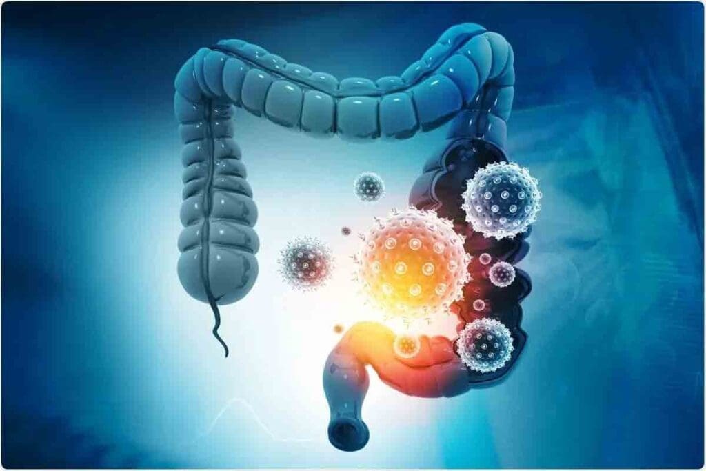 Colon Adhesions: 7 Critical Facts on Bowel Obstruction
