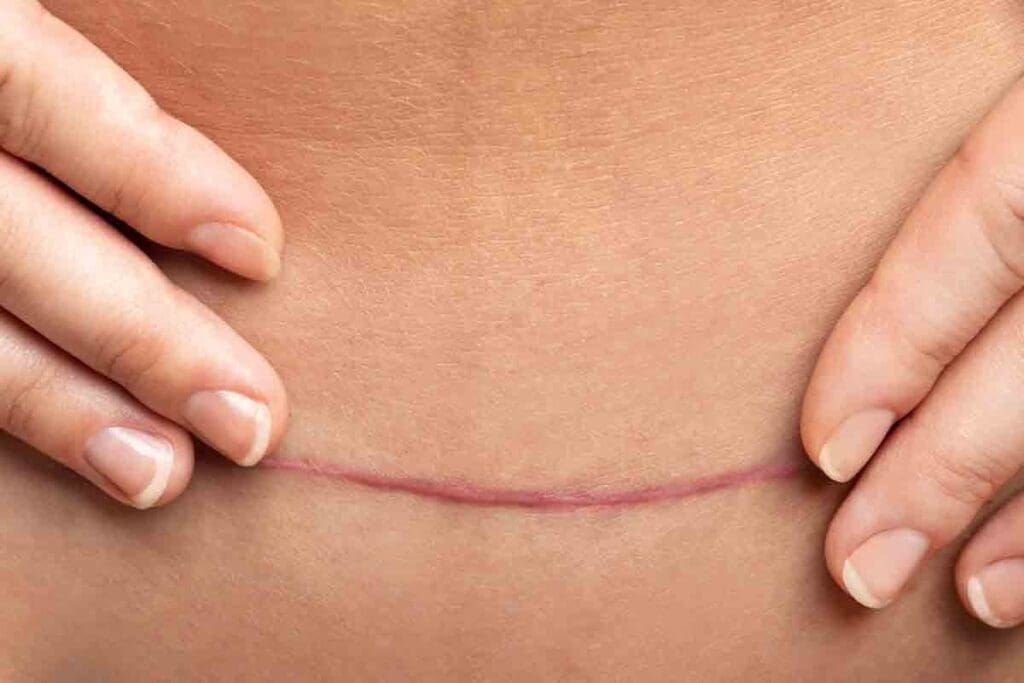 Adhesion Removal Surgery: Your Ultimate Guide