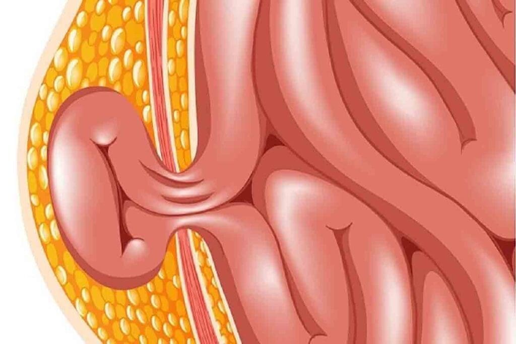Ventral Hernia vs Umbilical: The Critical Facts 3 Ventral Hernia vs Umbilical: The Critical Facts