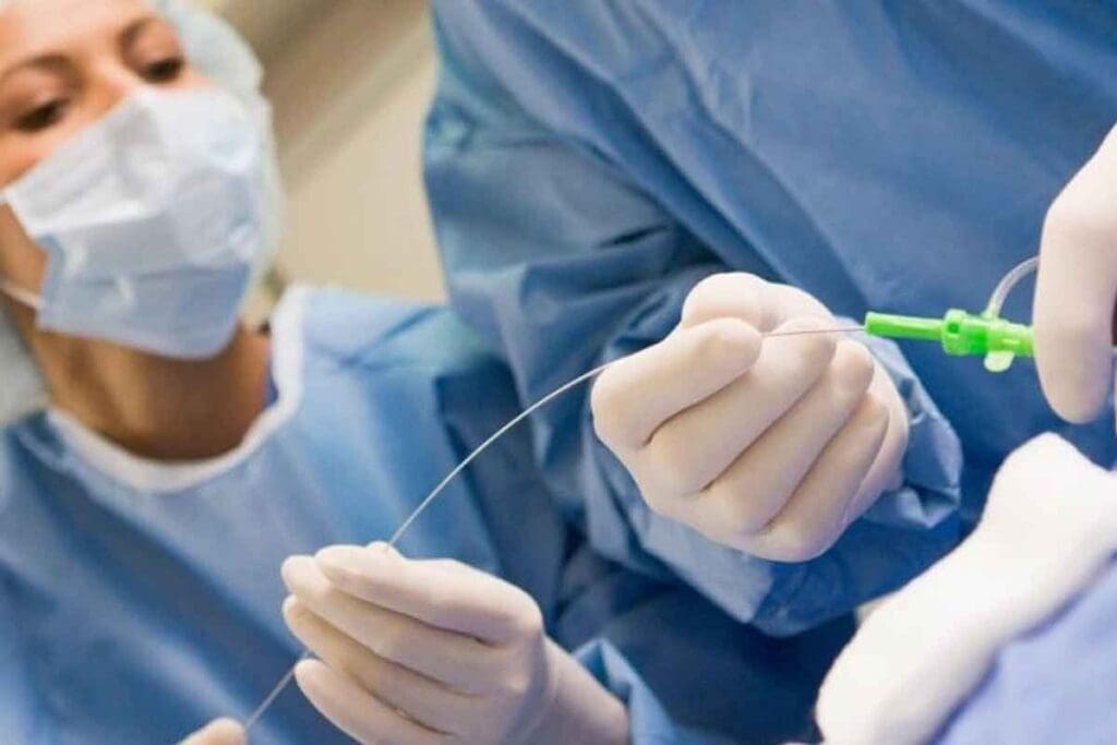 Endarterectomy vs Angioplasty: Key Facts