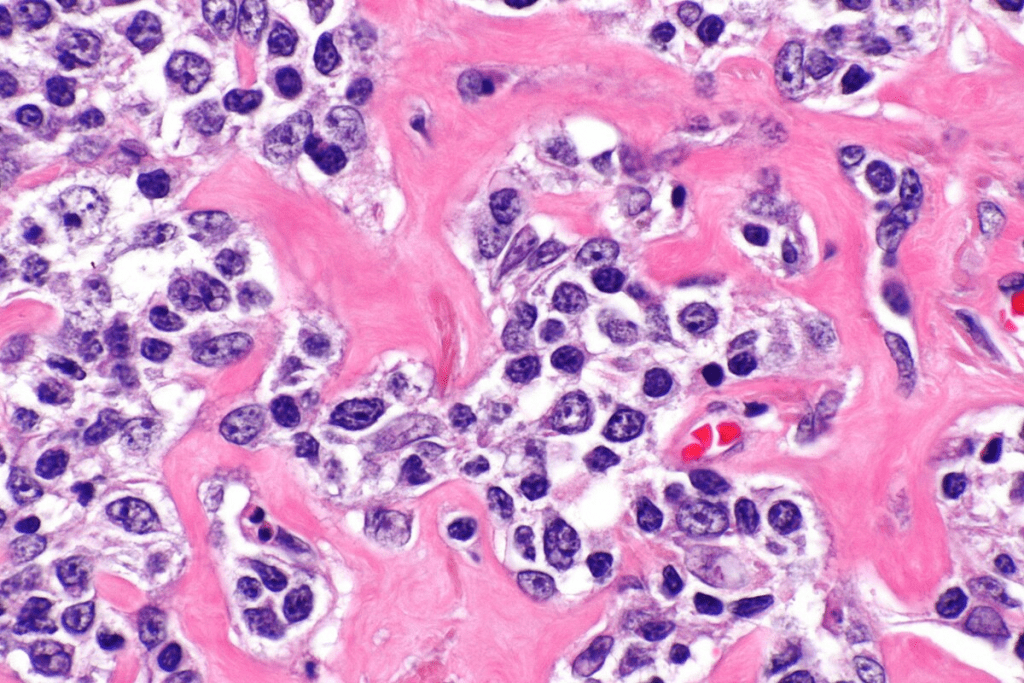 Lymphoma: Crucial Powerful Presentation in Children