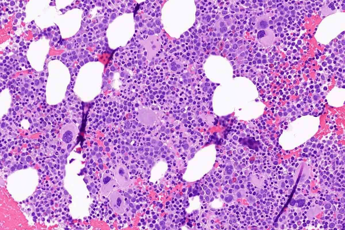 Aplastic Anaemia: 7 Key Facts You Need to Know About Causes, Symptoms, and Diagnosis