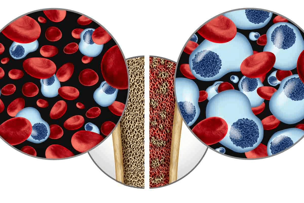 10 Non Cancerous Bone Marrow Disorders: Types, Symptoms, and Treatments