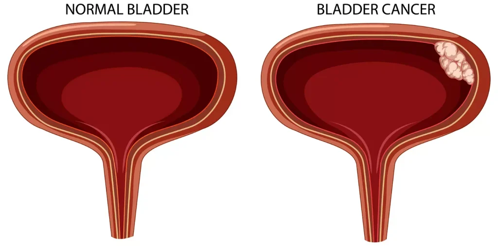 image depicting a normal bladder and one with non-muscle invasive bladder cancer, including papillary, carcinoma in situ, and superficial tumors