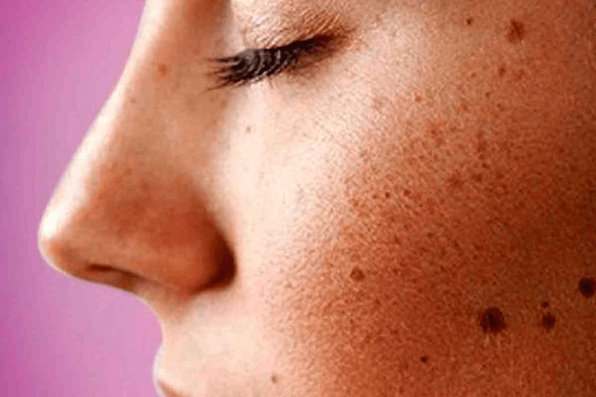 Skin Cancer on Scalp: What It Looks Like 3 Skin Cancer on Scalp: What It Looks Like