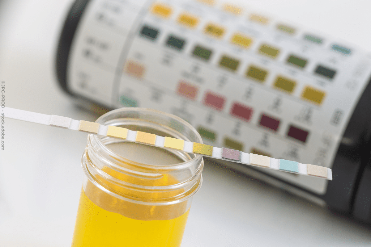 Types of Crystals in Urine: Meaning Explained