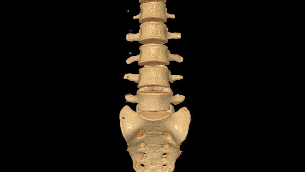 is a bulging disk the same as a herniated disk