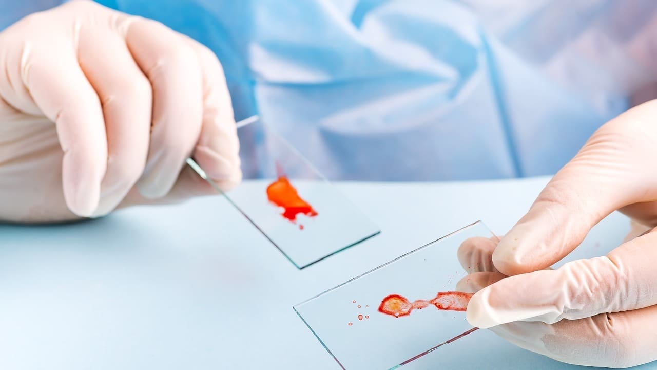 is blood cancer aml is curable