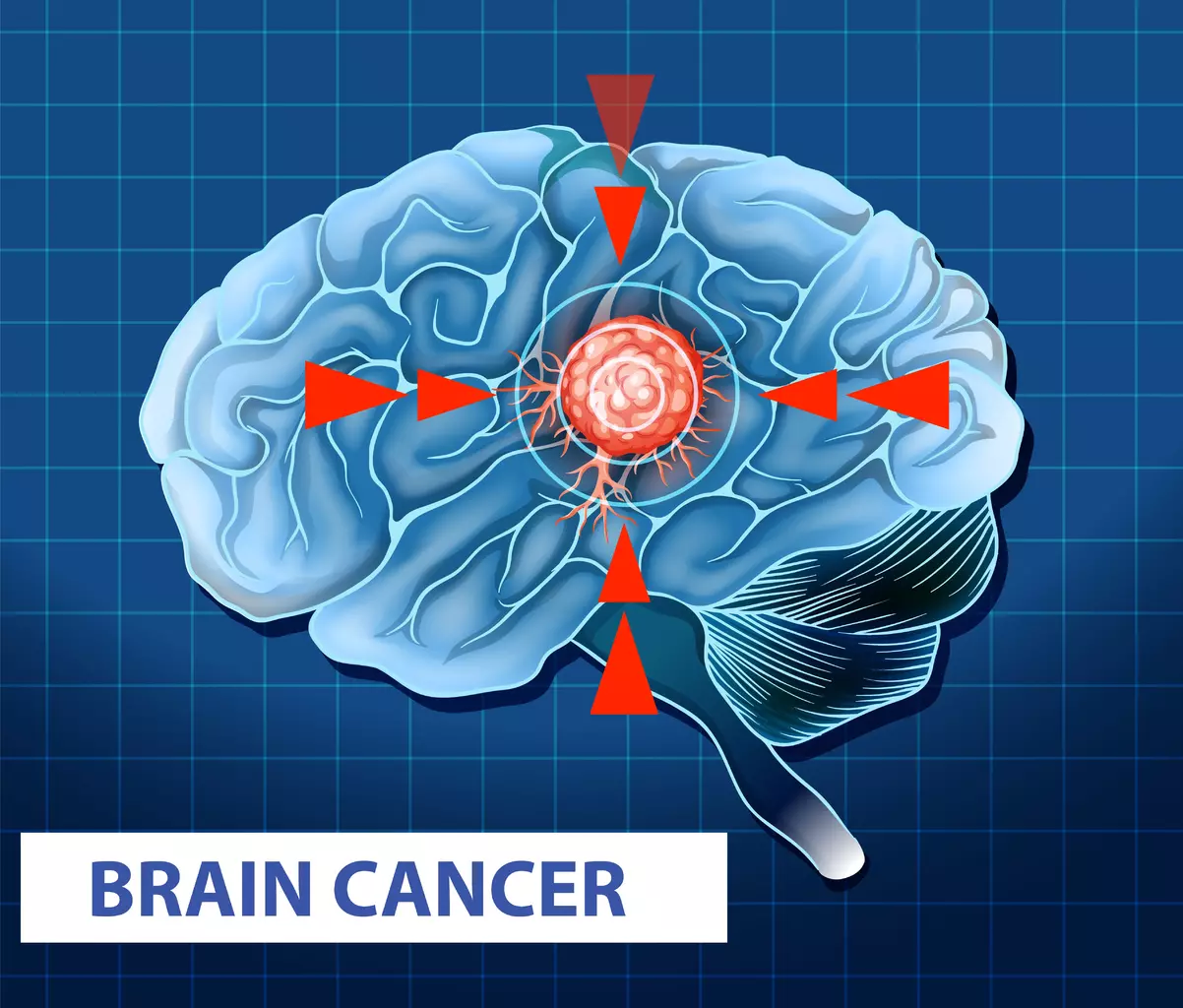 is brain tumor curable