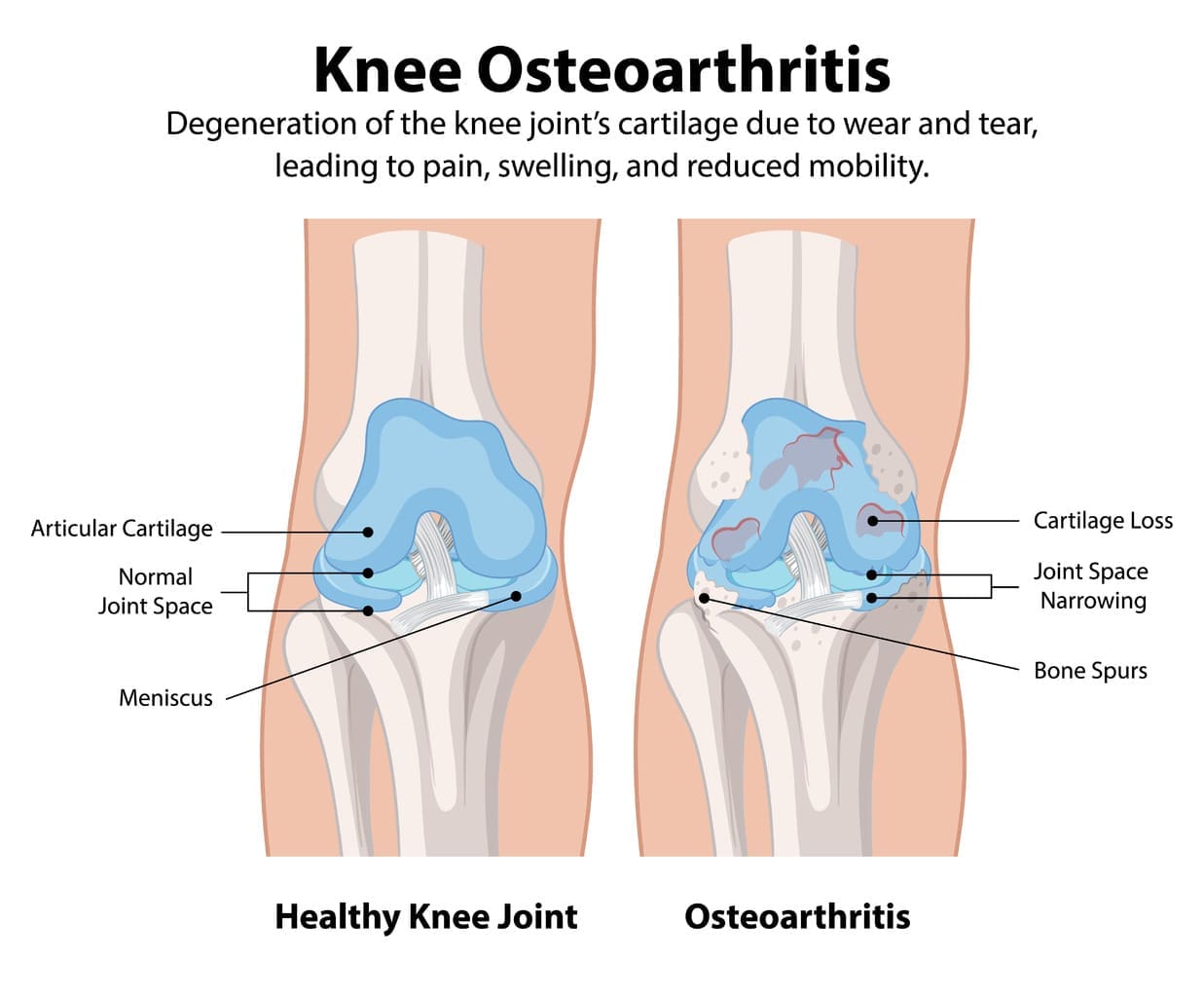 knee arthritis