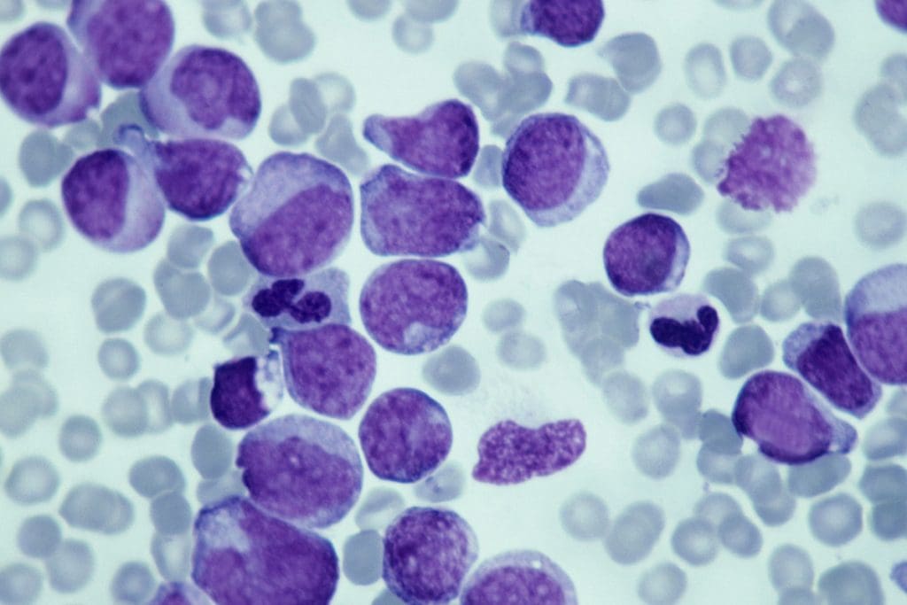 leucemia mieloide cronica LIV Hospital