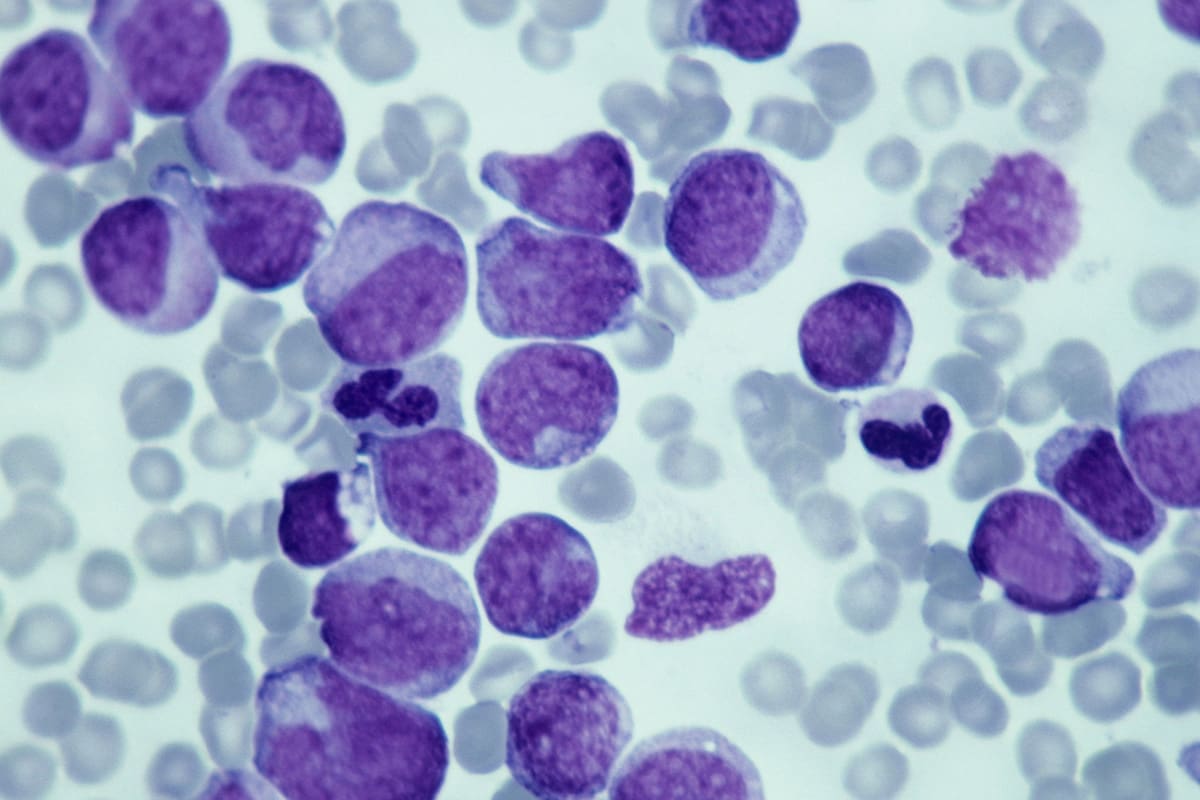 Early Warning: What Was the First of the signs of leukemia in Your Child?
