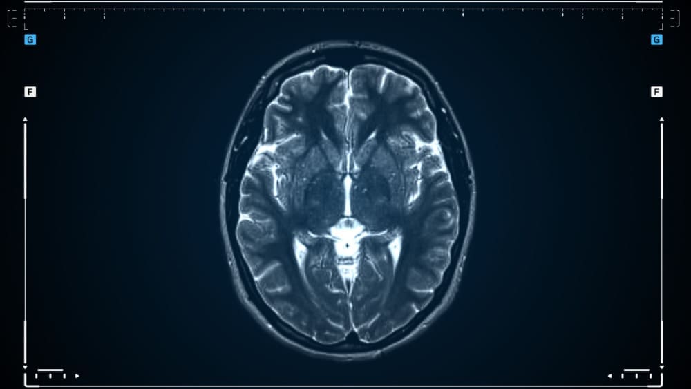 meningioma brain scan
