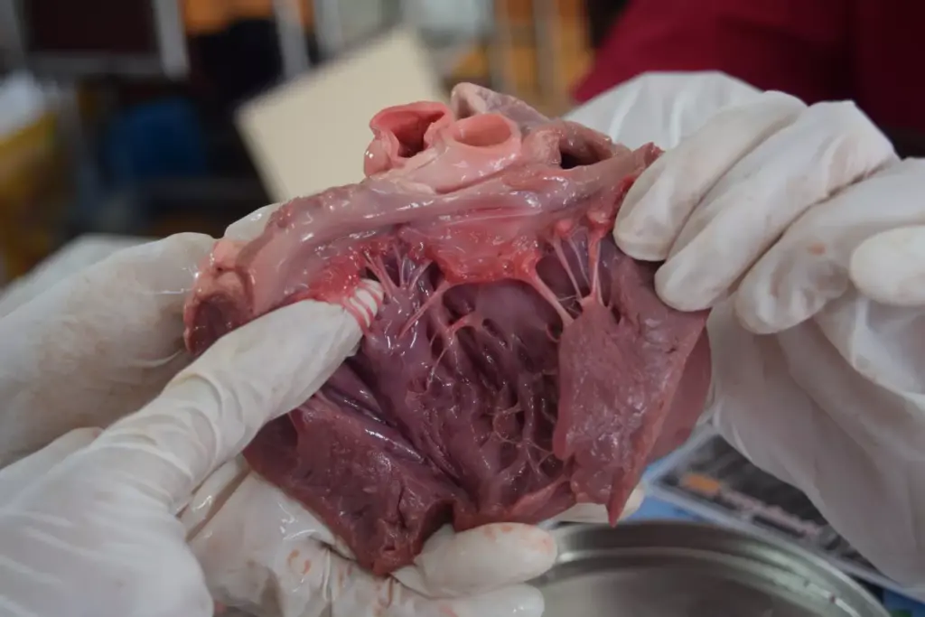 What Does a Mildly Dilated Aortic Root and Ascending Aorta Mean for Your Health?