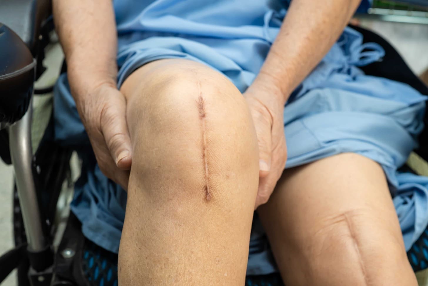 partial knee replacement scar