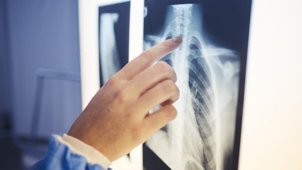 spinal fusion surgery recovery expectations
