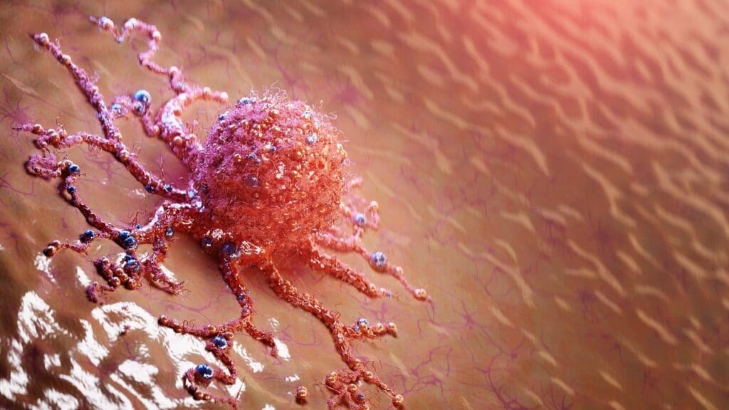 stage 4 cancer metastasis