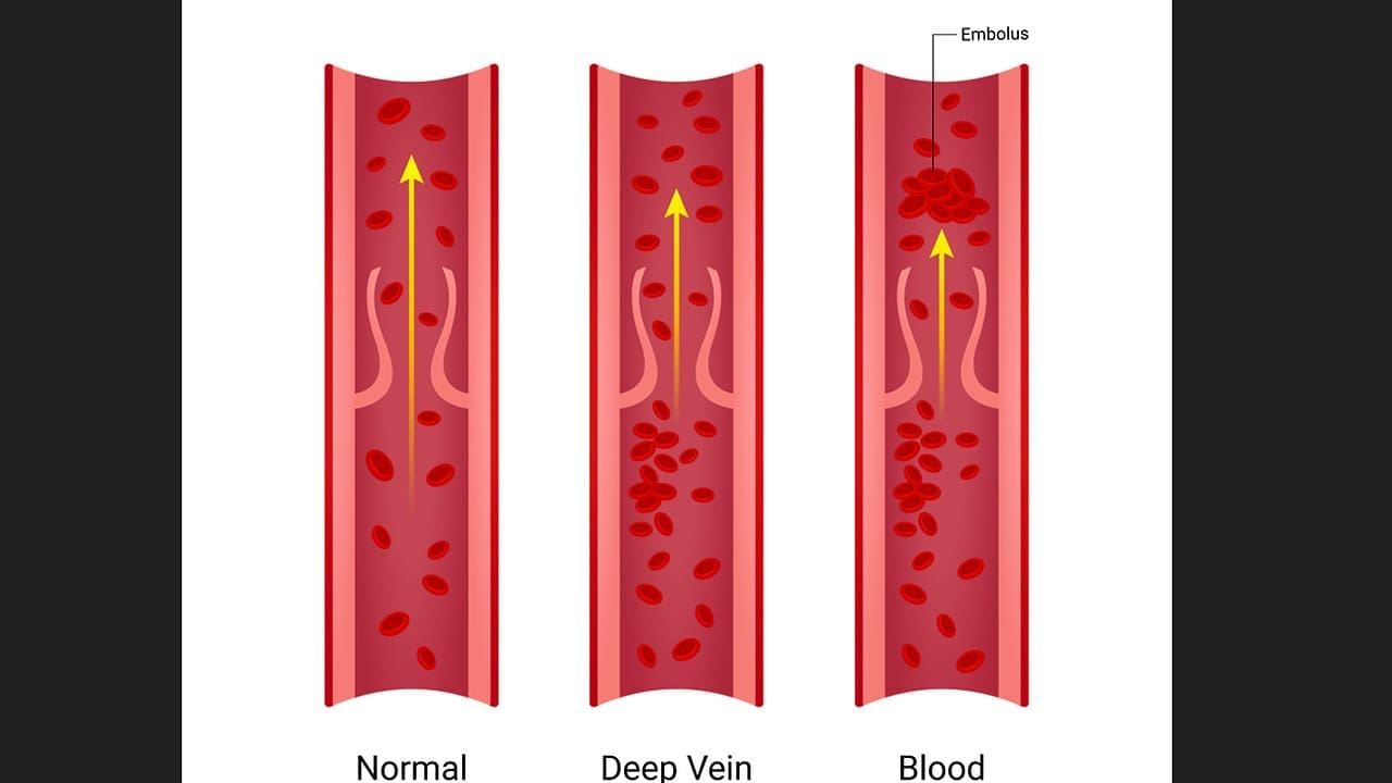 thrombosis occlusion