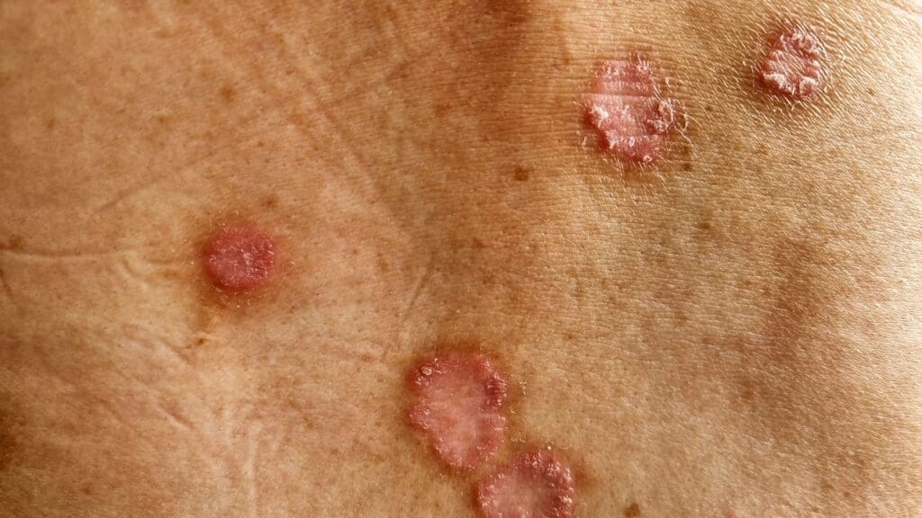 types of skin cancer