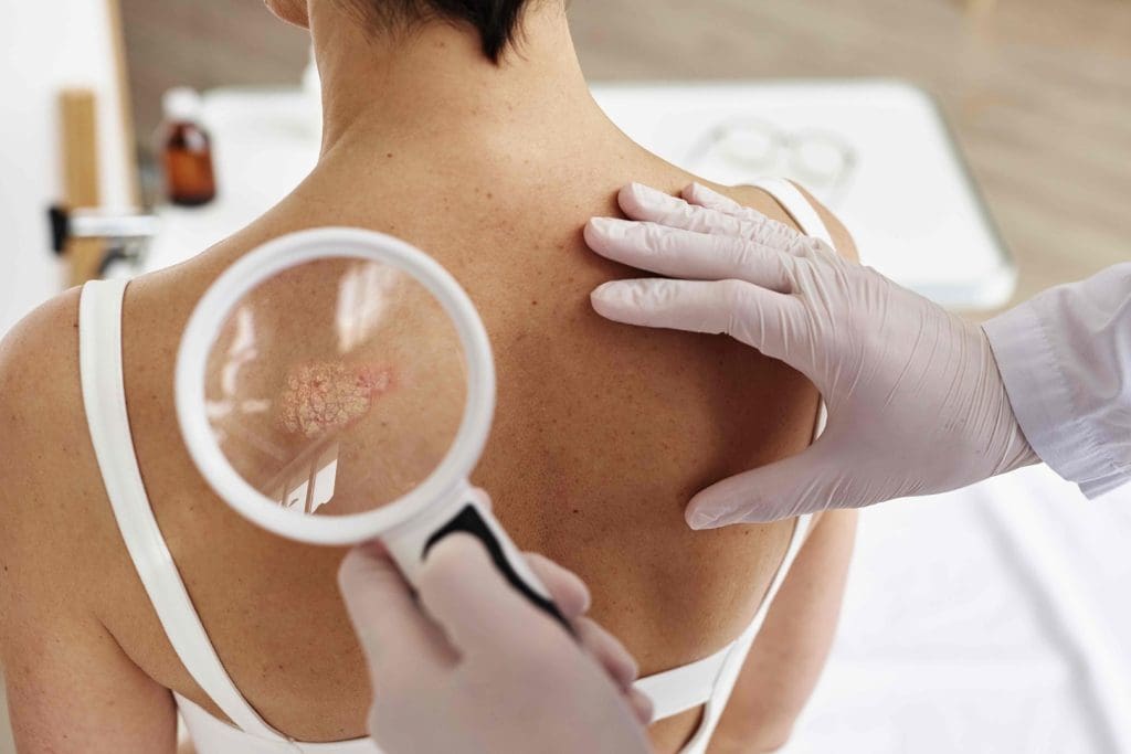 various skin cancer types and their removal methods