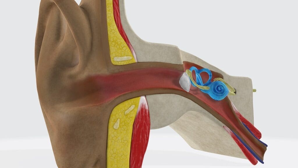 vestibular schwannoma risk factors