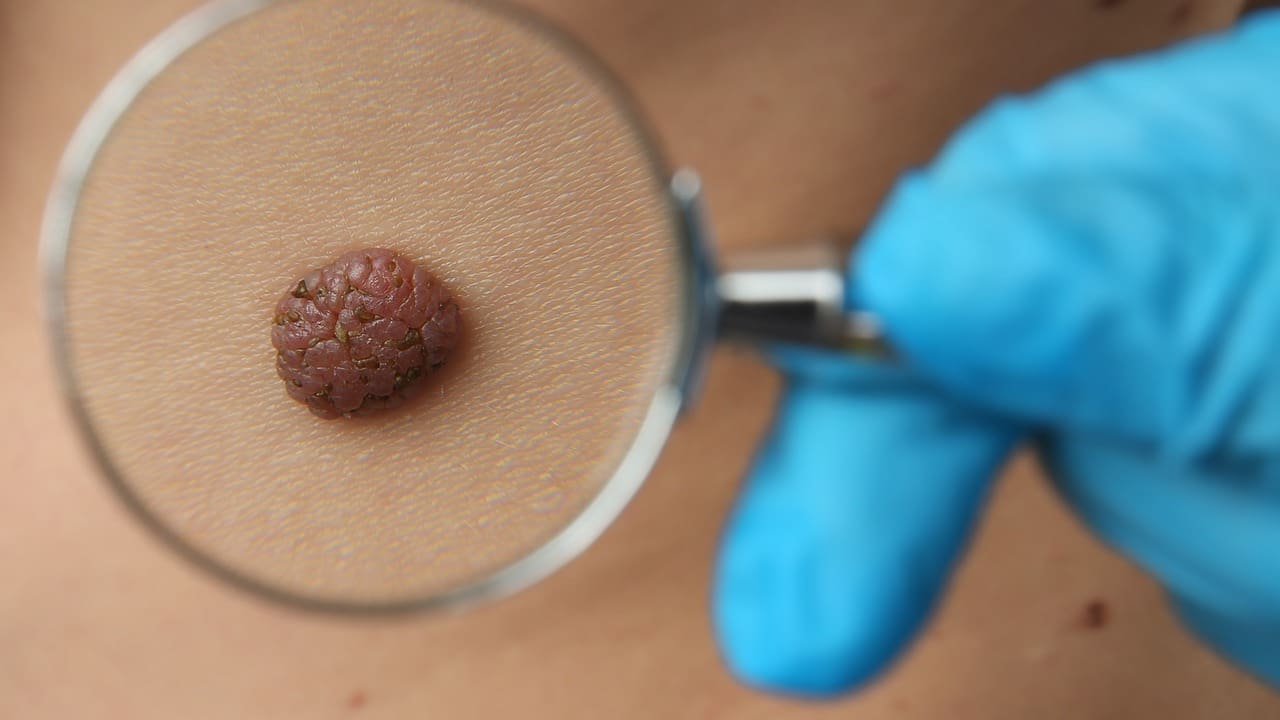 what happens if skin cancer goes untreated