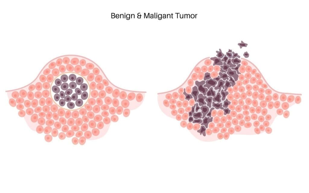 Malignant vs Benign Cancer: 8 Key Differences in Tumor Behavior 1 Malignant vs Benign Cancer: 8 Key Differences in Tumor Behavior