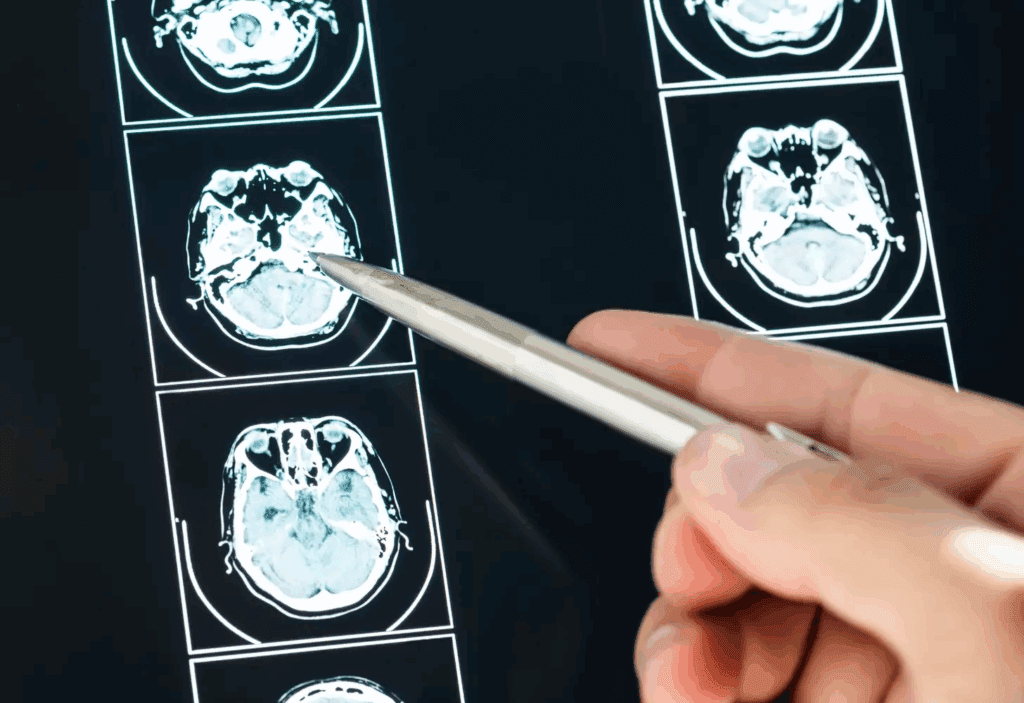 What Could Lesions on the Brain Mean and What Are the Symptoms to Watch For?
