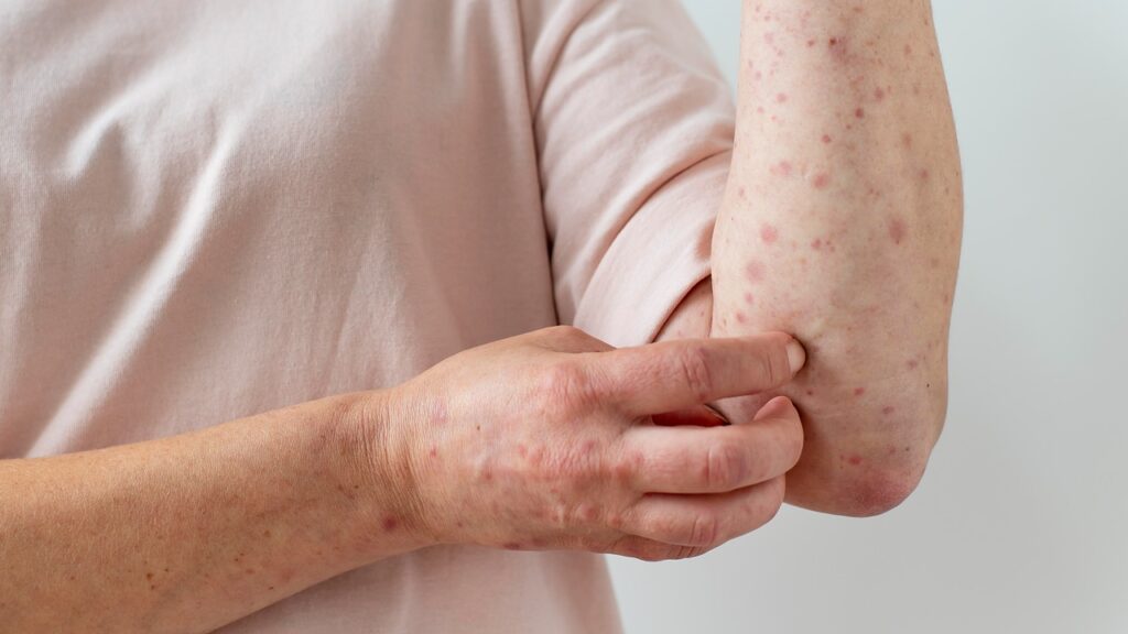 Urticaria Symptoms