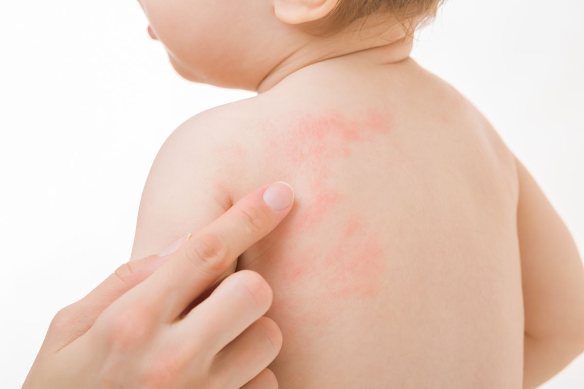 Urticaria Definition: Critical Facts Guide